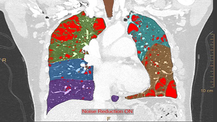 CT COPD