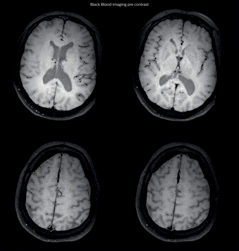 Black blood imaging pre contrast