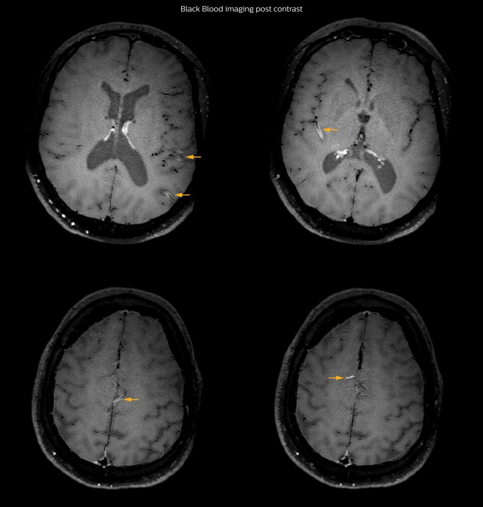 Black blood imaging post contrast