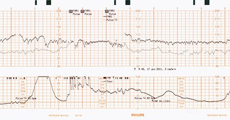 papel monitor fetal