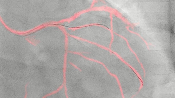 Hoja de ruta de Dynamic Coronary