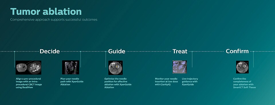 Infografía sobre la ablación de tumores