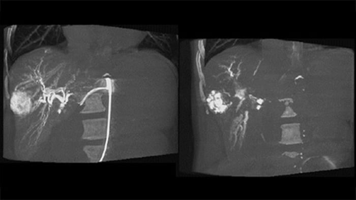 Imágenes 3D después de la embolización con CBCT