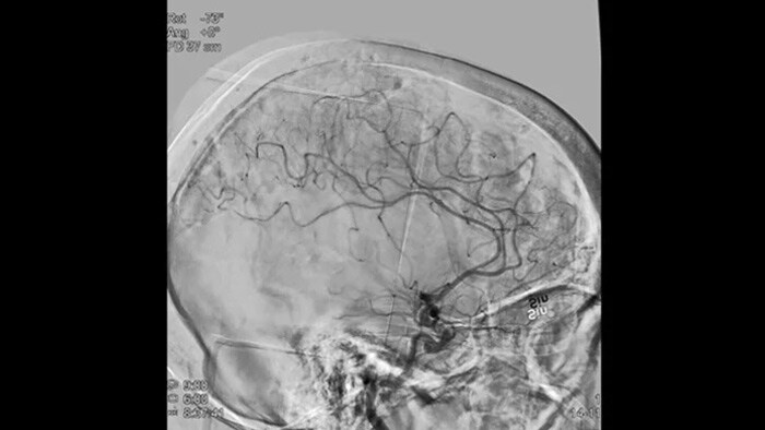 Angiografía por sustracción digital (ASD) 2D con tecnología ClarityIQ