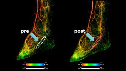 Arteria Tibial Posterior (PTA)