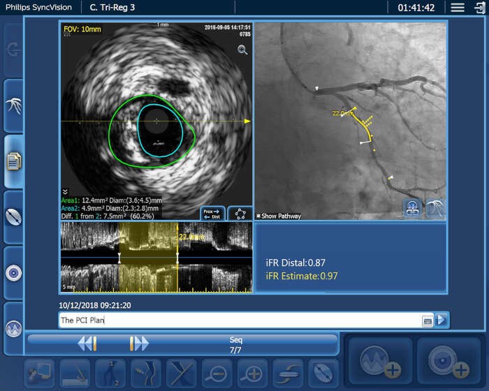 IntraSight Tri-regestration video