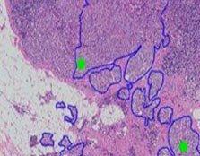 Apoyar a los patólogos para diagnosticar más rápido