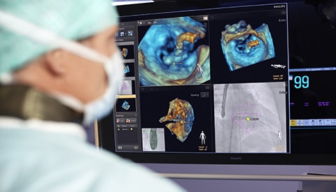 Haciendo la diferencia con la guía mediante imágenes en vivo de Philips en la cardiopatía estructural