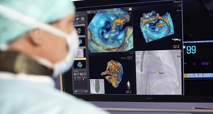 Tratamiento de la cardiopatía estructural con intervención guiada por imagen