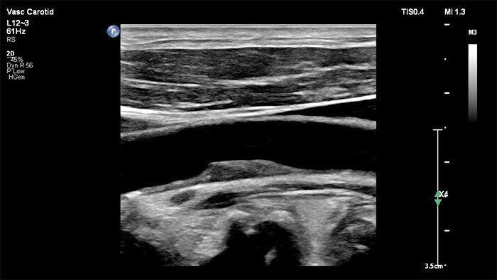 Fiabilidad diagnóstica durante la adquisición de imágenes vasculares