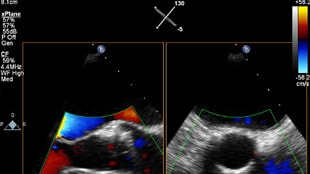 Puede examinar a los datos 3D en vivo para ayudar a planear TAVR