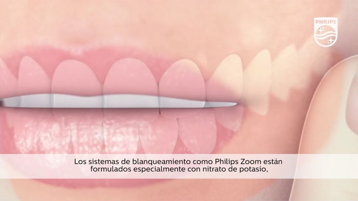 Vídeo de lo qué causa la sensibilidad en los dientes