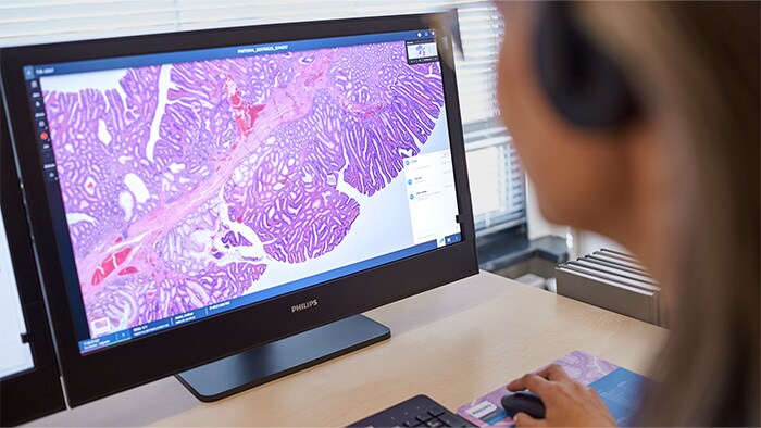 Atención precisa para el cuidado del cáncer