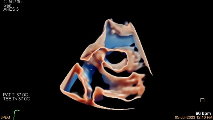 3D View of young pediatric patient heart view 