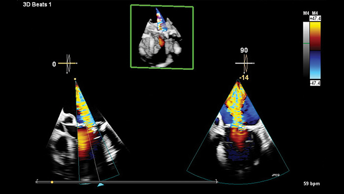 Mini 3D TEE transducer clinical view